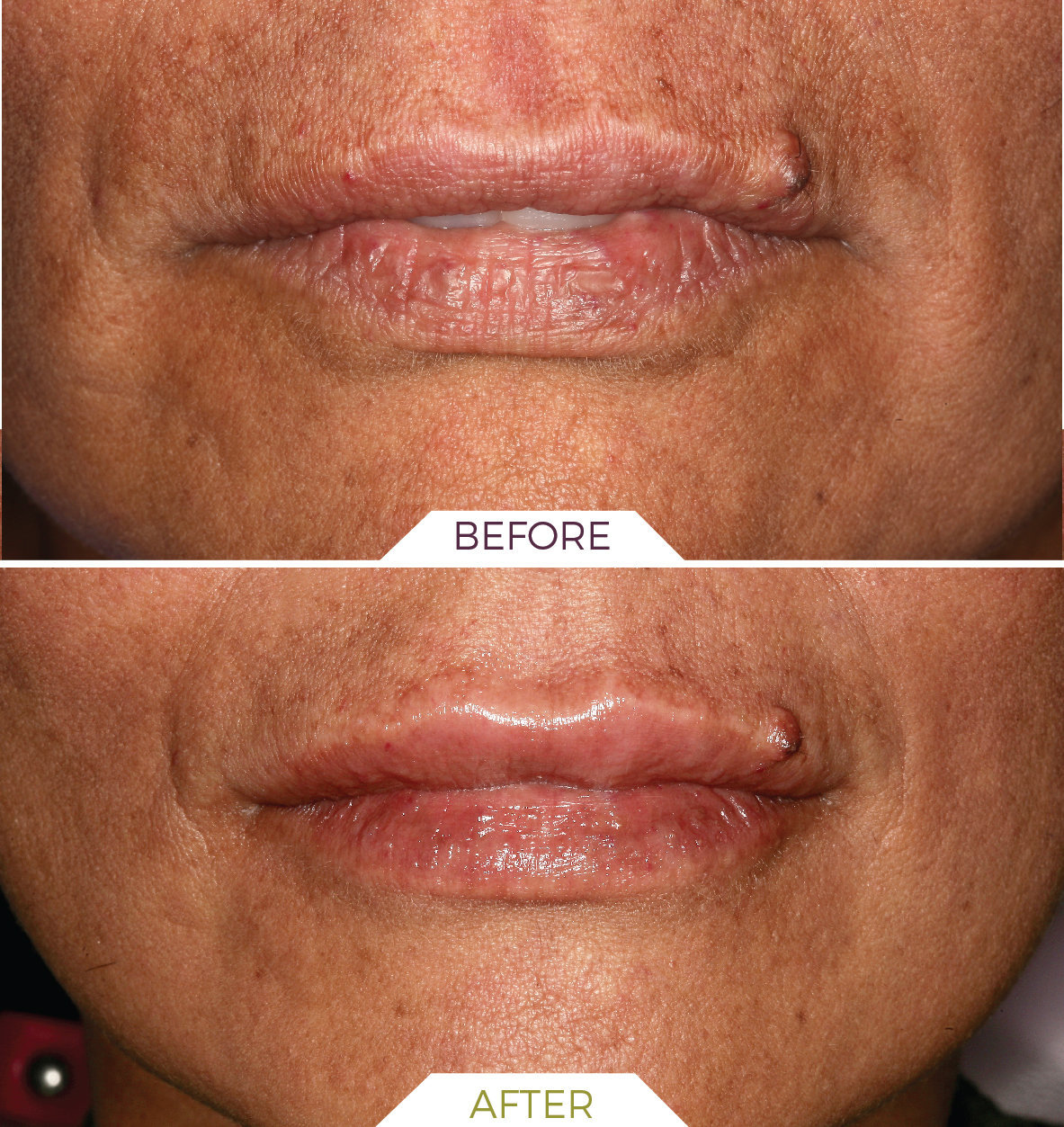 Inlaser- Medicina Estetica ING-01