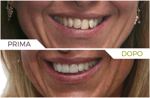 Faccette dentali - InLaser